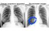 Рентгенова диагностика на респираторни заболявания - вирусна пневмония